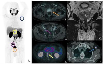 Case report: PSMA PET/CT addresses the correct diagnosis in a patient with metastatic prostate cancer despite negative core biopsies and mpMRI. A diagnostic challenge